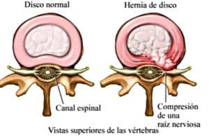 Capataz seta fútbol americano Hernia de disco, 5 preguntas sobre la hernia discal | Invaar