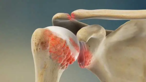 Artrosis glenohumeral, tambien conocida como osteoartritis de hombro