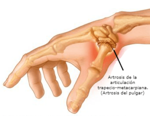 Rizartrosis (artrosis de la articulación trapecio-metacarpiana)